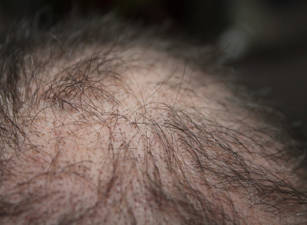 Alopecia: cause, sintomi, diagnosi, trattamento e prevenzione